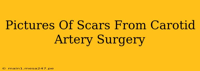 Pictures Of Scars From Carotid Artery Surgery